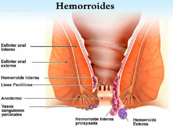 Remedios caseros para Las Hemorroides