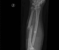 Remedios caseros en para fracturas múltiples y de cráneo