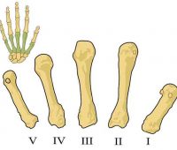 Remedios caseros para las fracturas de dedos, manos y tibia