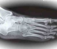 Remedios caseros para las fracturas en el pie