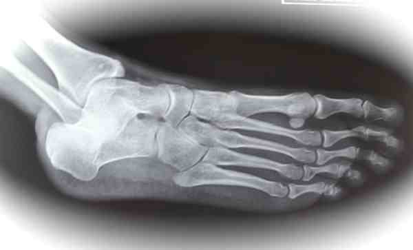 Remedios caseros para las fracturas en el pie