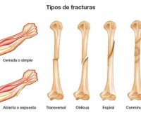 Remedios caseros para las heridas con espinas y fiebre