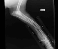 Remedios caseros por fractura del húmero