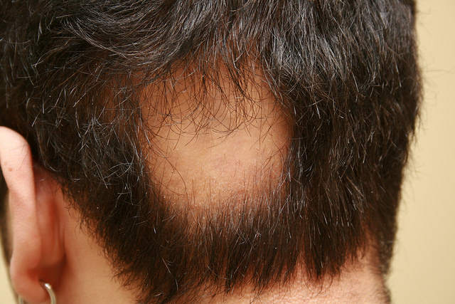 Remedios Caseros para la Alopecia